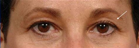 Eyelid Thermage Before and After Pictures | Santa Monica Laser and Skin Care Center