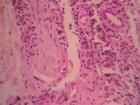 Significance of Histopathology in Leprosy Patients with 1-5 Skin ...