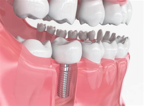 Your Guide to the Different Types of Dental Implants