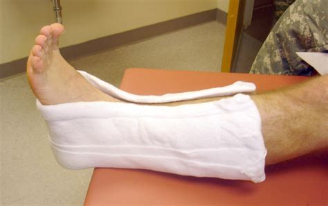 Splints and Casts: Indications and Methods | AAFP