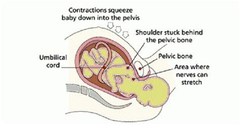 Shoulder Dystocia - www.medicoapps.org