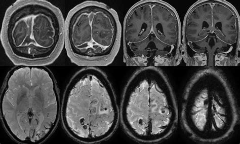 Dural Sinus Thrombosis