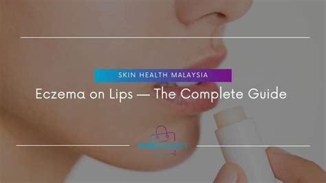 Eczema On Lips - Symptoms, Treatment And Prevention