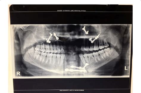 Postoperative orthopantomogram. | Download Scientific Diagram