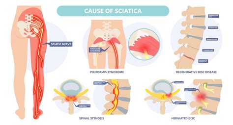Sciatica: Causes, conservative care, surgery, and injection treatments ...