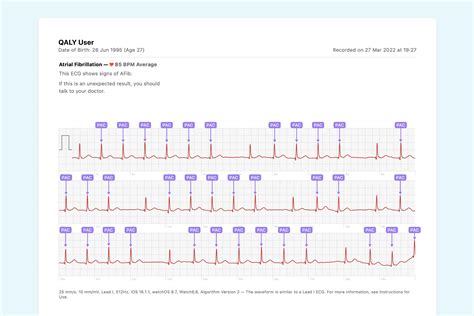 What Ectopic Atrial Rhythm Looks Like on Your Watch ECG | Qaly