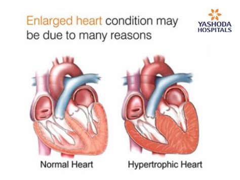 Enlarged heart condition is also called as Cardiomegaly, which is not a disease but a signal for ...