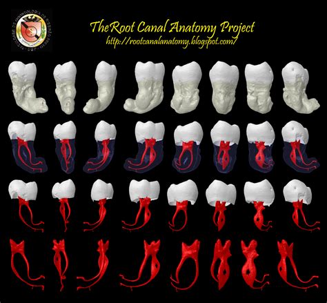 The Root Canal Anatomy Project: Mandibular Third Molar