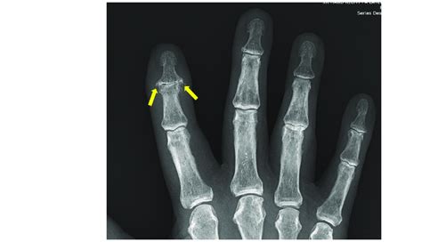 79-year-old male with psoriatic arthritis. Hand radiographs demonstrate ...