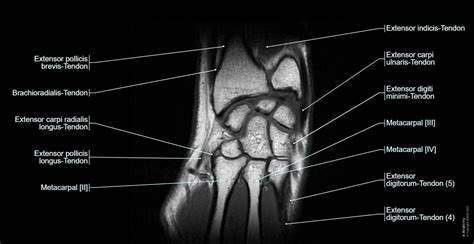 Ulnar Collateral Ligament Wrist Mri