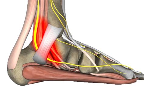 ETF Clinical Case: Tarsal Tunnel Syndrome - O'Brien Medical