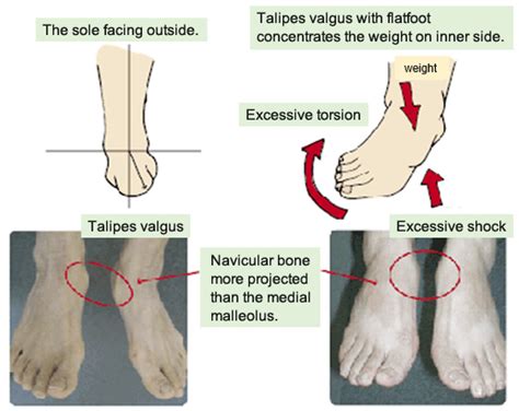 Pain and projection of Navicular bone | KASAHARA FOOT CARE