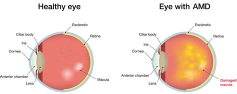 A Clear View of Common Retinal Diseases Affecting Vision - Healthy ...