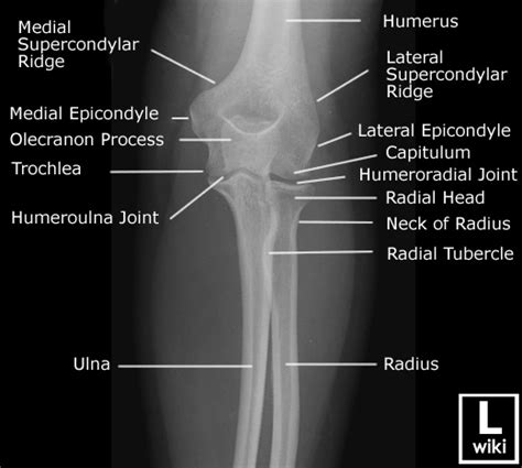 Radiographic Anatomy of the Elbow – RADIOLOGYPICS.COM