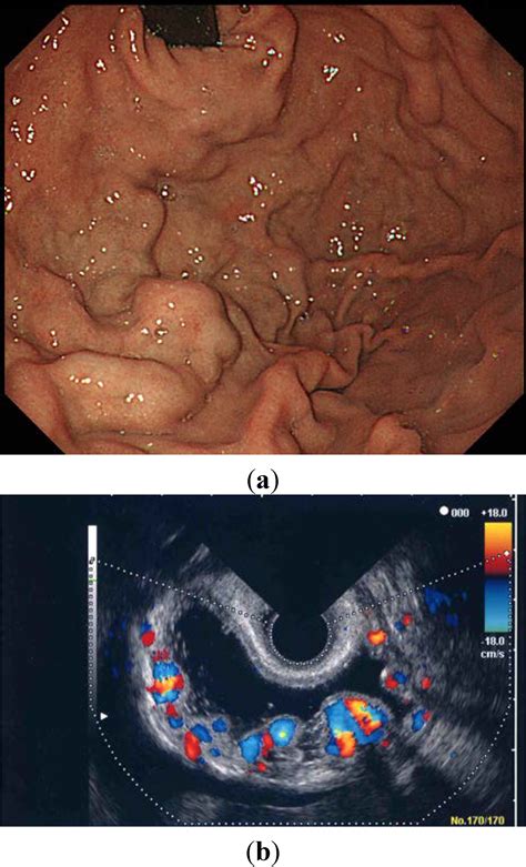 Diagnostics | Free Full-Text | Endoscopic Color Doppler ...