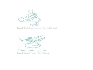 Shoulder dystocia management | PPT