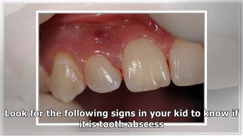 Abscessed Tooth In Child - Causes, Symptoms And Treatment - YouTube