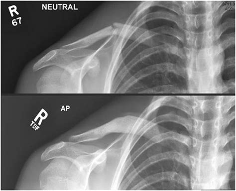 Ppt Diagnosis And Treatment Of Clavicle Fractures Powerpoint