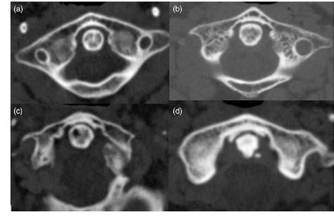 Figure 1 from The prevalence of osteoarthritis of the atlanto-odontoid ...