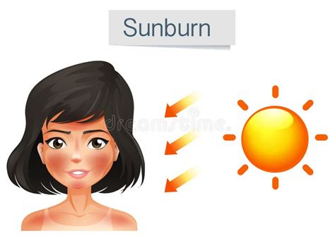 Sunburn Clipart Stock Illustrations – 284 Sunburn Clipart Stock ...