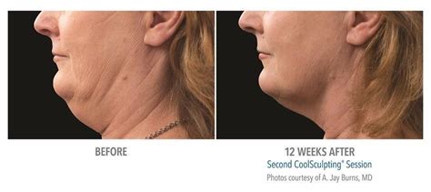 Get Rid of Your Double Chin | Chin Fat Reduction | Los Angeles LA CA