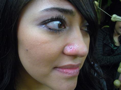 Nose Piercing Infection Bump - FUNGAL INFECTION IN NAILS