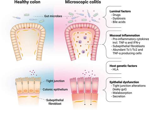 Microscopic Colitis Causes, Symptoms, Diagnosis & Treatment