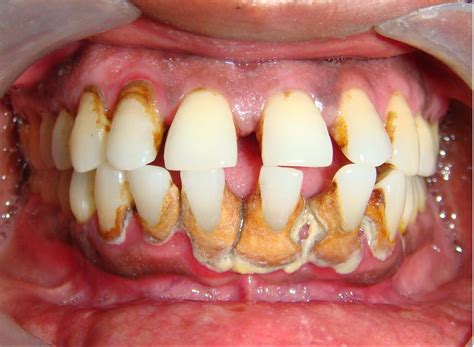 Dentistry lectures for MFDS/MJDF/NBDE/ORE: A NOTE ON DENTAL CALCULUS