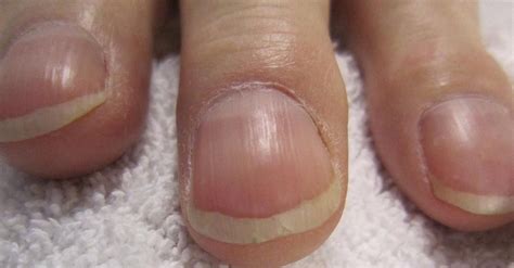 13 Common Symptoms of Liver Disease Fake Nails Shape, Types Of Fake Nails, Crazy Nails, Fun ...