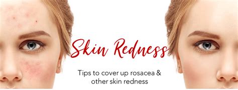 Skin Redness | Makeup Tips for Redness & Makeup for Rosacea