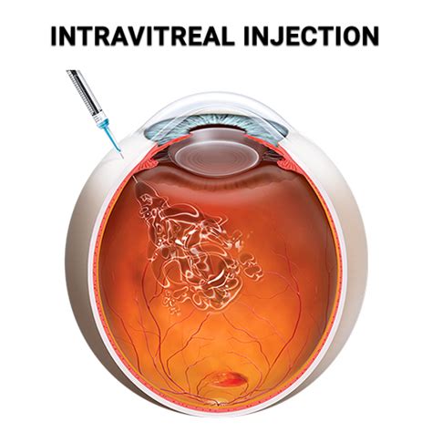 Intravitreal Injection - Vitreous Retina Macula Consultants of New York