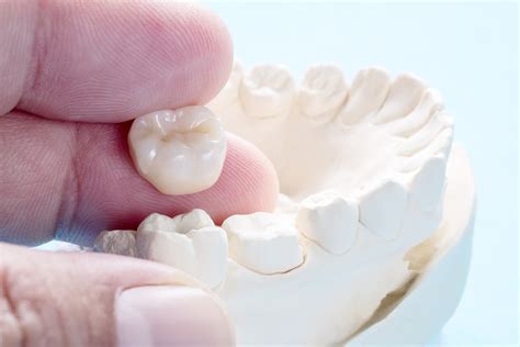 How Bad Can A Tooth Be And Still Get A Crown? | Suwanee, GA