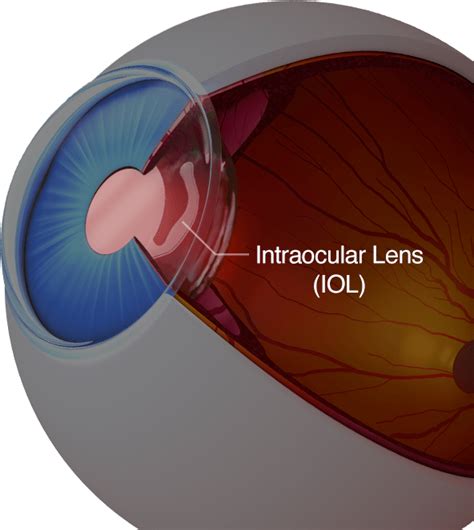 What IOL stands for? Can Iol Be removed? Can IOL be replaced? Which Iol Lens is best? Masters ...