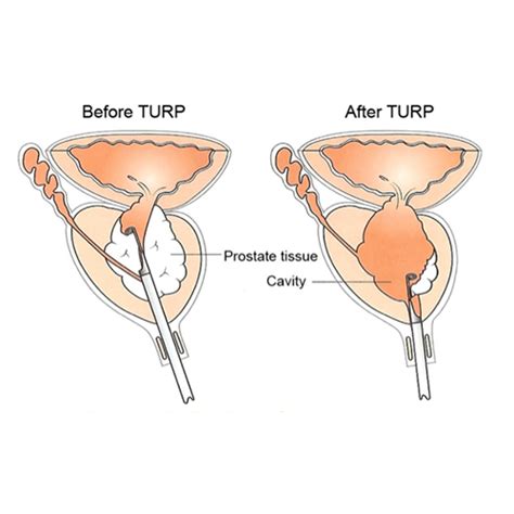 TURP Surgery - Advin Urology