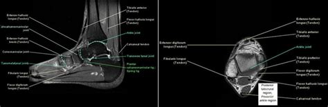 MRI imaging Techniques: MRI Technologist Role in Foot/Ankle Positioning