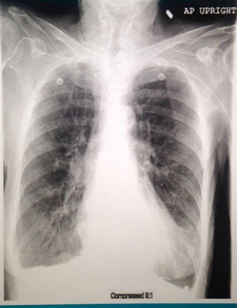 This is a Patient with lung hyperinflation from COPD. Increased work of breathing causes ...