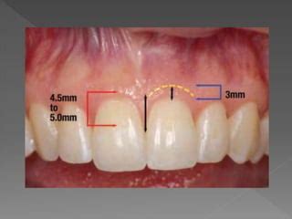 Biologic width - Importance in Periodontal and Restorative Dentistry