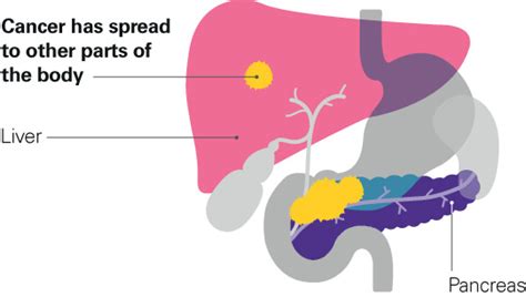 Stage 4 pancreatic cancer - Pancreatic Cancer UK