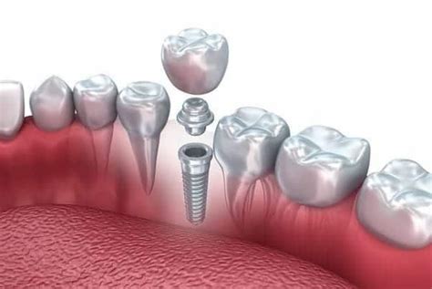 Implant-Supported Crowns – Scottsdale, AZ - Sonoran Dental Design