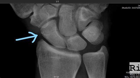 3 weeks into healing a scaphoid fracture x-ray. Any thoughts on healing time for this location ...