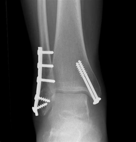 Ankle Fractures – Dr. Tim Dwyer