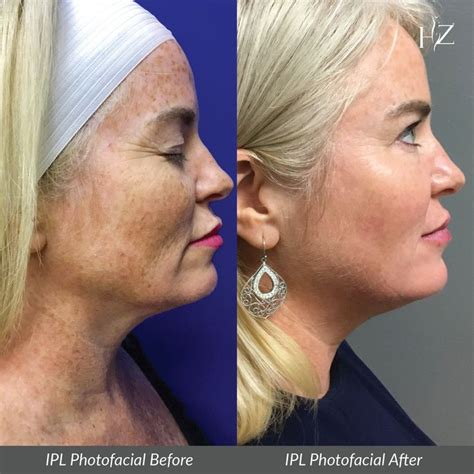 IPL Photofacial Before & After | Ipl photofacial, Photofacial, Plastic surgery