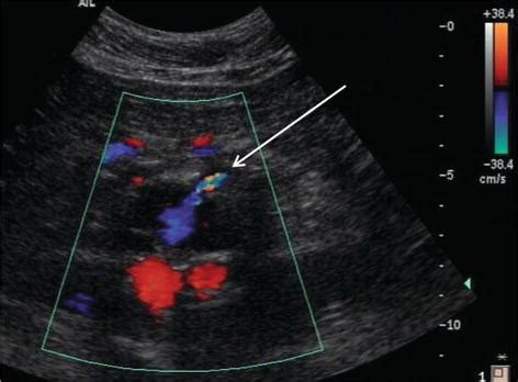 Treatment of the Progressive Endoleak Type 2 After EVAR | IntechOpen