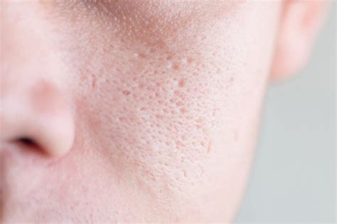 Large Pores: Causes, Preventions and Treatment - BodyCarre