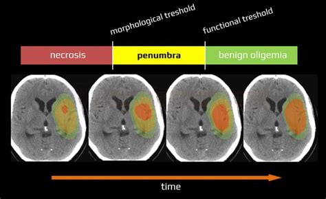 Ischemic penumbra | STROKE MANUAL