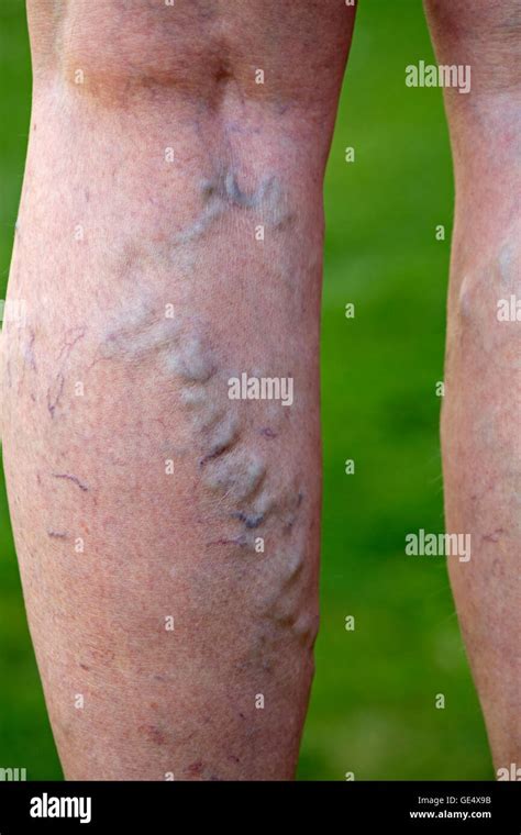 Varicose veins swollen enlarged veins and distorted skin in legs elderly woman UK Stock Photo ...