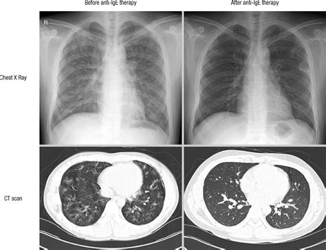 Successful Treatment of Chronic Eosinophilic Pneumonia with Anti-IgE Therapy