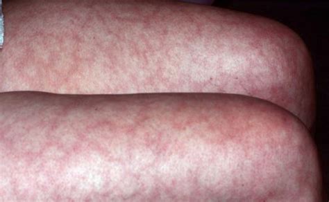 Livedo Reticularis - Causes, Pictures, Treatment, Symptoms