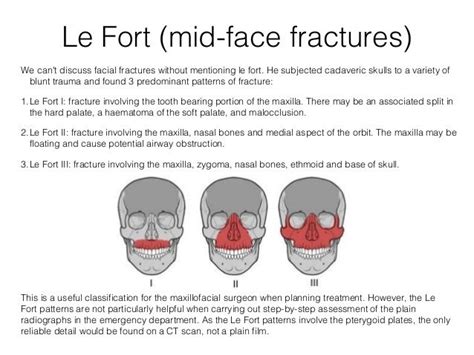 Le fort fracture - fieldpastor