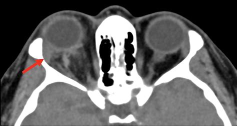 Cureus | A Rare Case of Vomiting-Induced Retrobulbar Hemorrhage